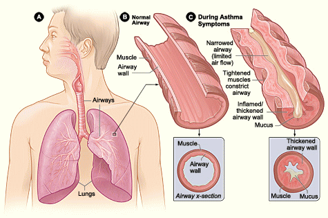 喘息の気管支イメージ